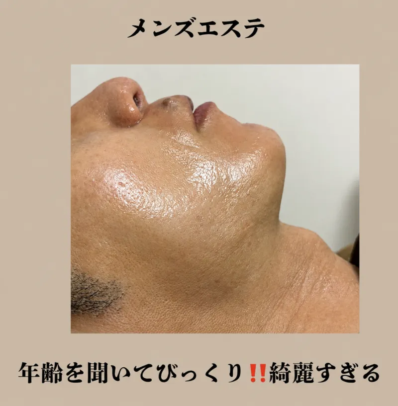 髭脱毛