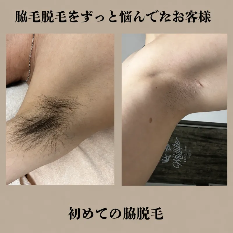 脇脱毛