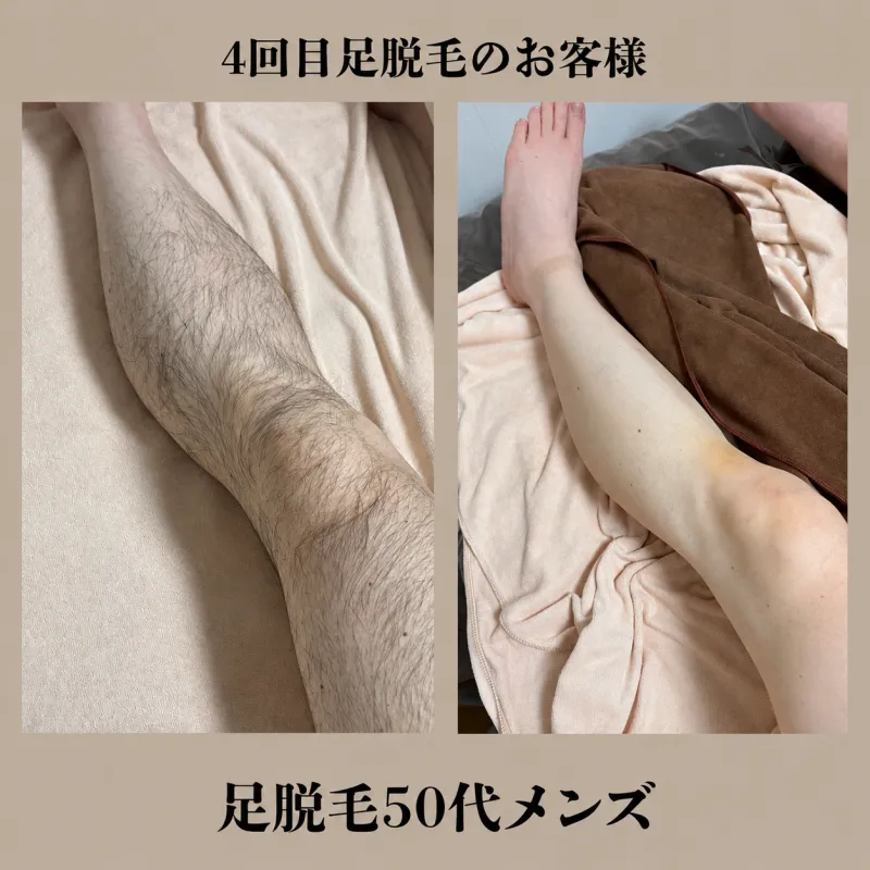 脚脱毛
