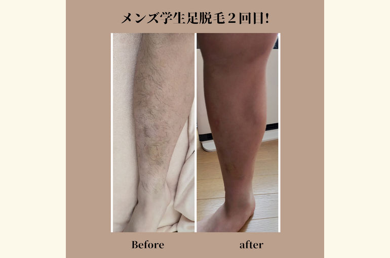 学生メンズ脱毛が安い、おすすめ安心の都度払いサロン