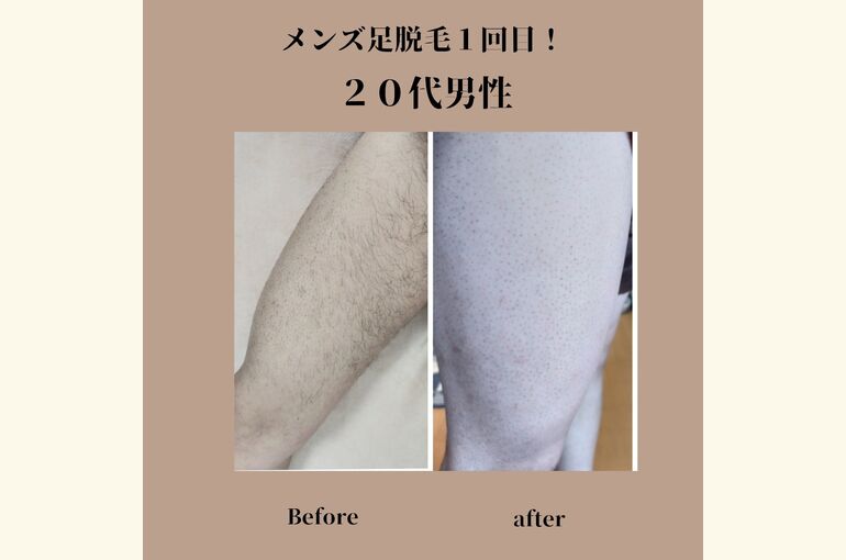 メンズ専門脱毛サロン、夏が来る前に綺麗に！足。腕脱毛が安い！