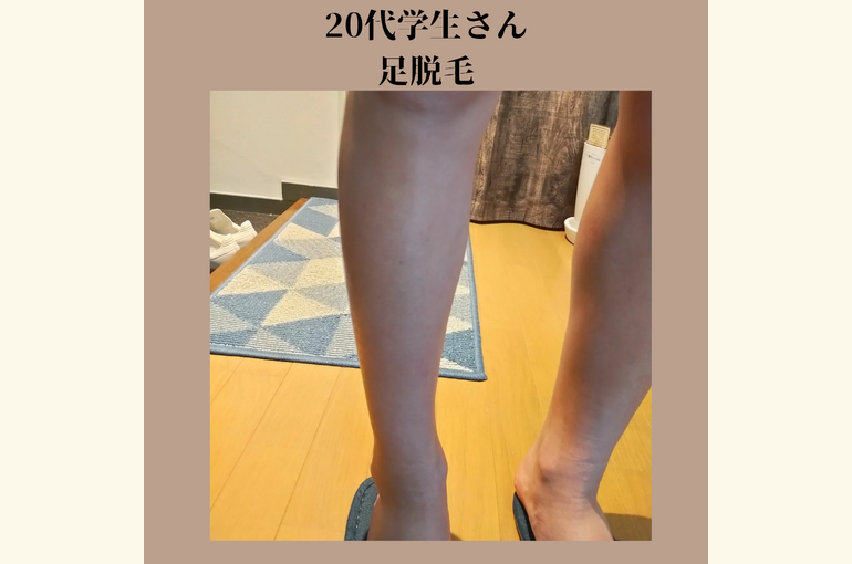 大学生メンズにも人気の足、脇脱毛。安心の都度払いサロン