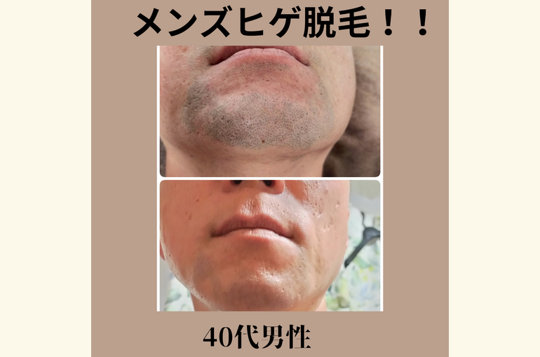 【メンズ】ヒゲ脱毛安い！都度払いの完全予約制 堺市北野田honey-house