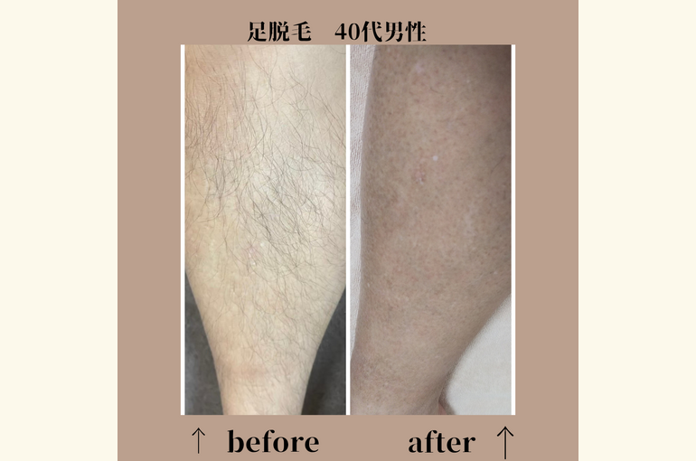 ゴルフの時も気にならない！足。腕脱毛でかっこよく短パンを履ける体へ！メンズ脱毛サロン北野田