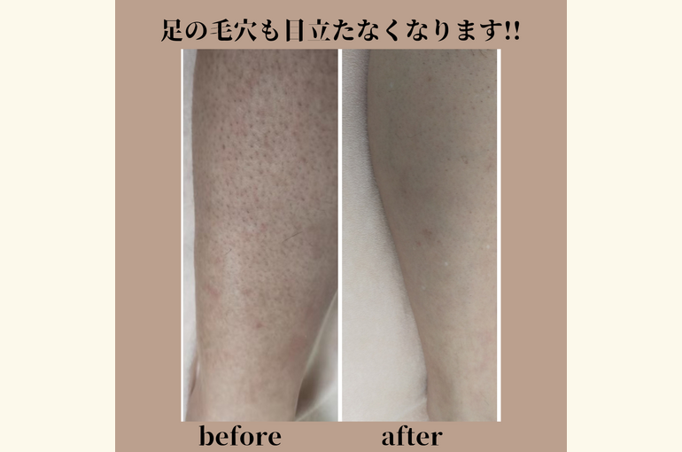 メンズ脱毛で、毛穴の無いお肌へしっとり肌触りの良いお肌へメンズ専門脱毛サロン