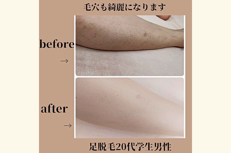 脱毛後の黒いブツブツのない足へ。メンズ足脱毛がおすすめ!