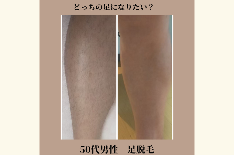 すね毛脱毛をして若くてきれいな足へ！メンズ専門脱毛サロン