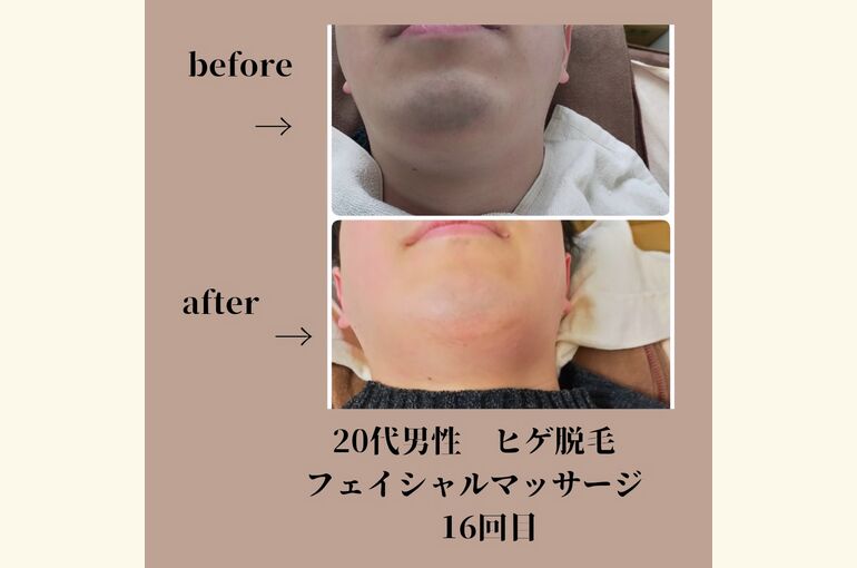 メンズヒゲ脱毛と、フェイシャルマッサージで若みえ！メンズ美容サロン