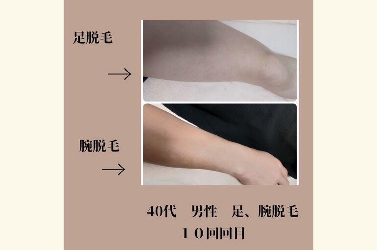 メンズ脱毛、腕。足脱毛で夏までにツルスベのお肌へ