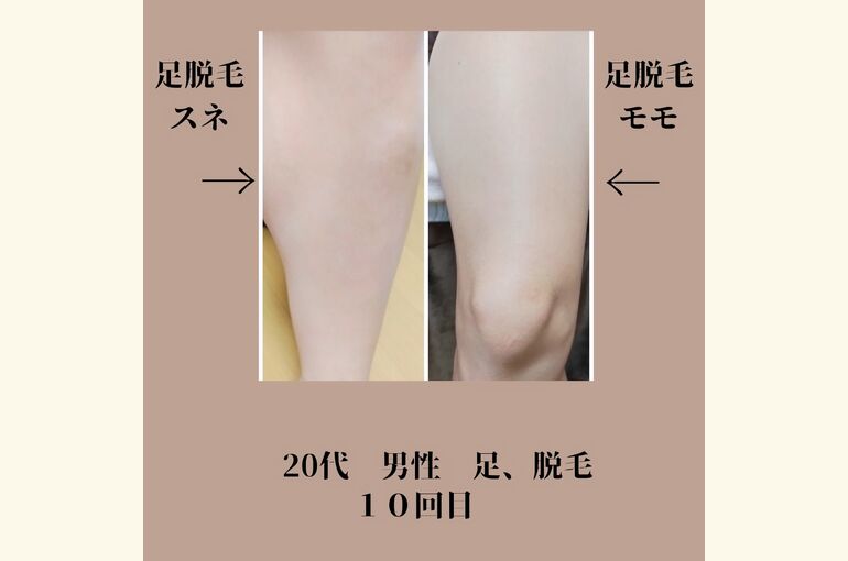 今からはじめるメンズ脱毛がオススメ！足、腕、ヒゲ脱毛いそげー！
