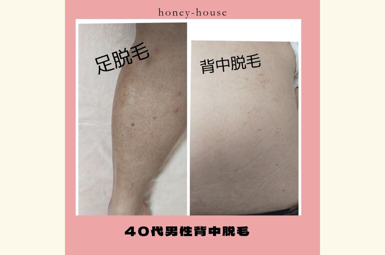 背中脱毛　毛が濃くてコンプレックスの方、今すぐ体験！メンズ脱毛