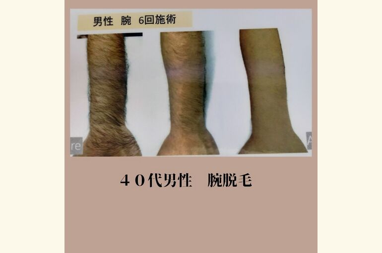 メンズ脱毛、足、腕、ヒゲ脱毛がオススメ！完全予約制脱毛サロン