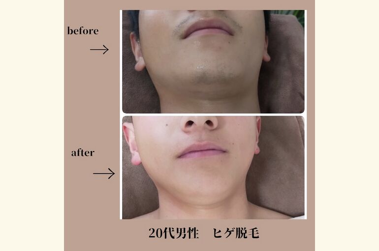 ヒゲ脱毛で、清潔感をてにいれて男前に！