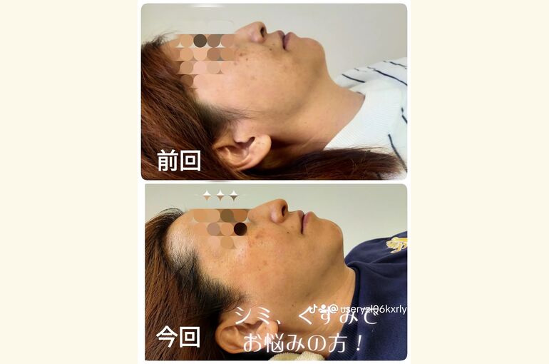 シミ、シワ、くすみでお悩みの方へ！光フォトで艶肌へ！！北野田駅すぐプライベートサロン