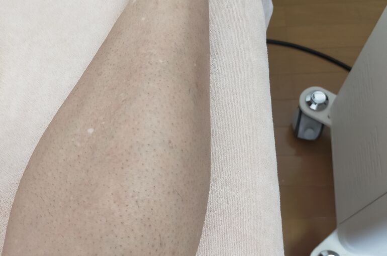 メンズ脱毛が安くて安心の都度払い制の完全個室脱毛サロン