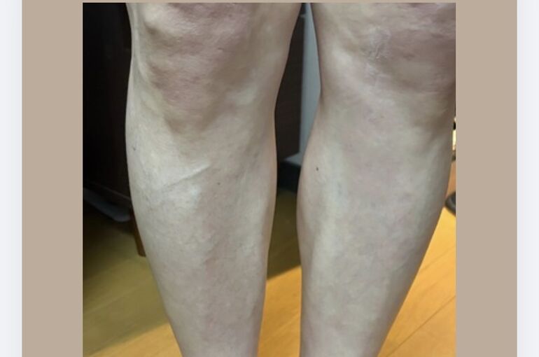 50代足脱毛‼️