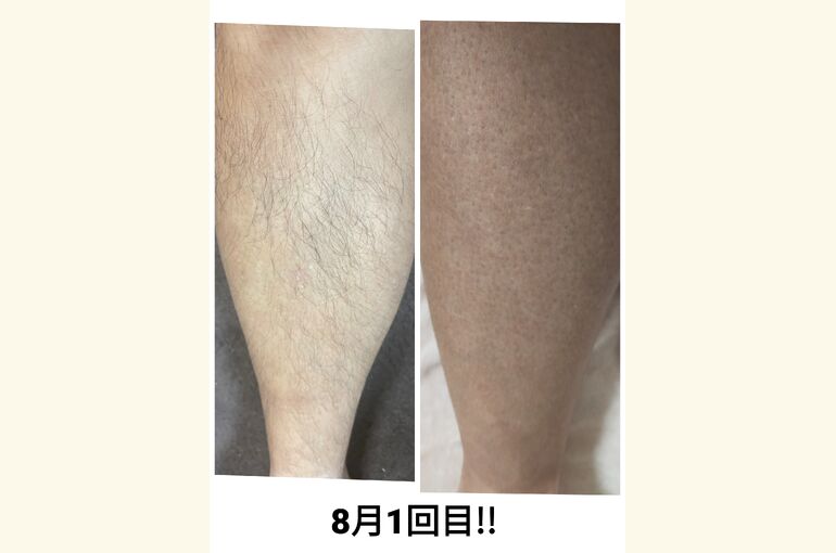 メンズ脱毛がオススメ！ヒゲ、足、ついでに顔もスッキリ！脱毛サロン