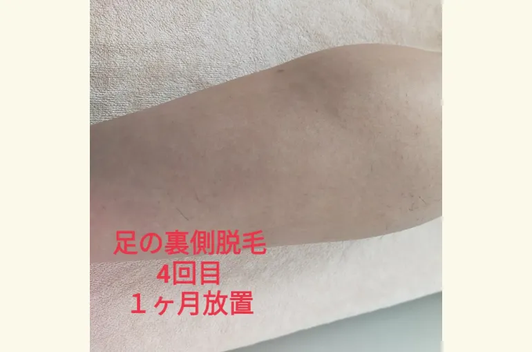 【メンズ】ヒゲ、足脱毛が安い!!完全予約制 堺市北野田honey-house