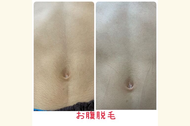 【北野田の脱毛サロン】キッズ脱毛、メンズ脱毛！お腹も綺麗に！