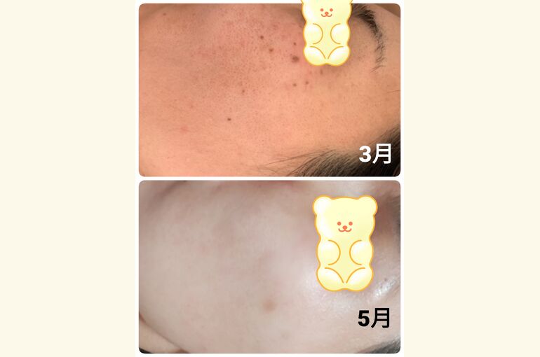 シミ、くすみ、リフトアップに、光フォトフェイシャル【堺市北野田駅 徒歩3分 プライベートサロン】honey-house