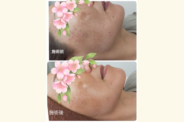 【堺市北野田 honey-house】お肌に、ハリ、ツヤを！美肌フォトフェイシャル