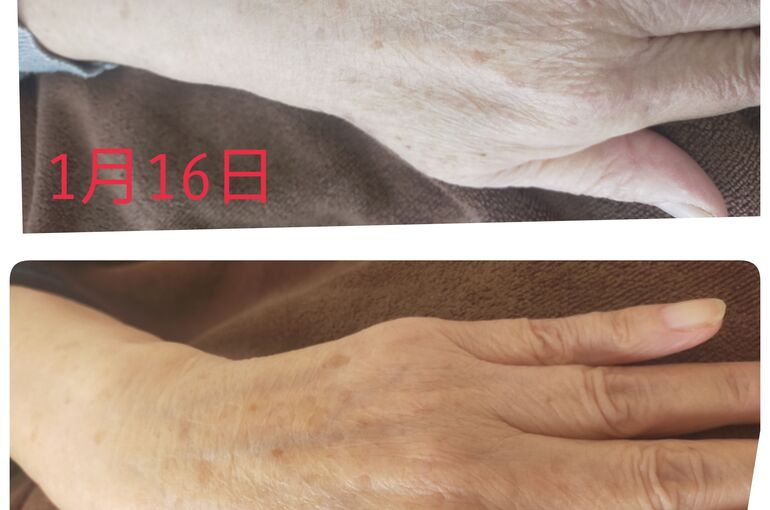 美肌フォトフェイシャルで、シミケアも、ハンドケアもご一緒に！【⠀堺市北野田プライベートサロン】