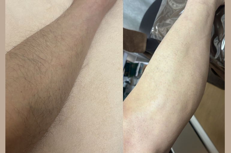 人生初めてのメンズ脱毛