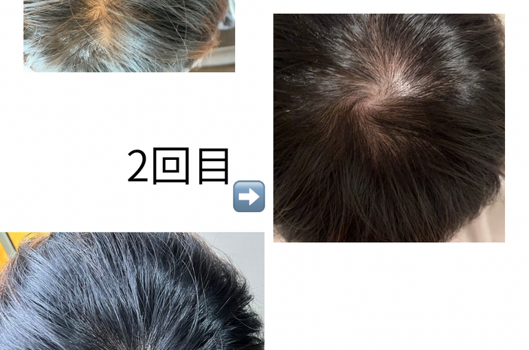 スカルプケアお薬を辞めてもいい感じ