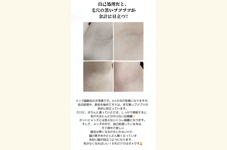 メンズ脇脱毛￥990！自己処理は絶対に辞めて！黒ずみになる！