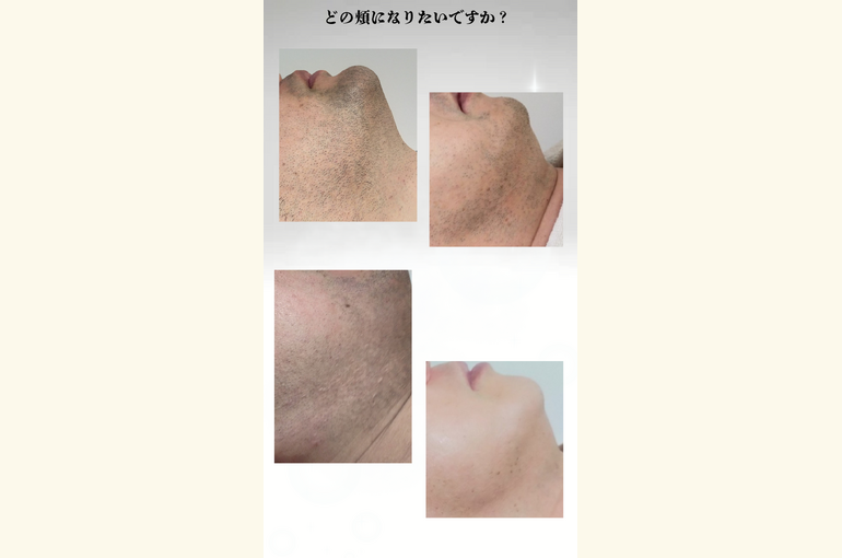 メンズヒゲ脱毛、頬の毛、どの頬になりたいですか？