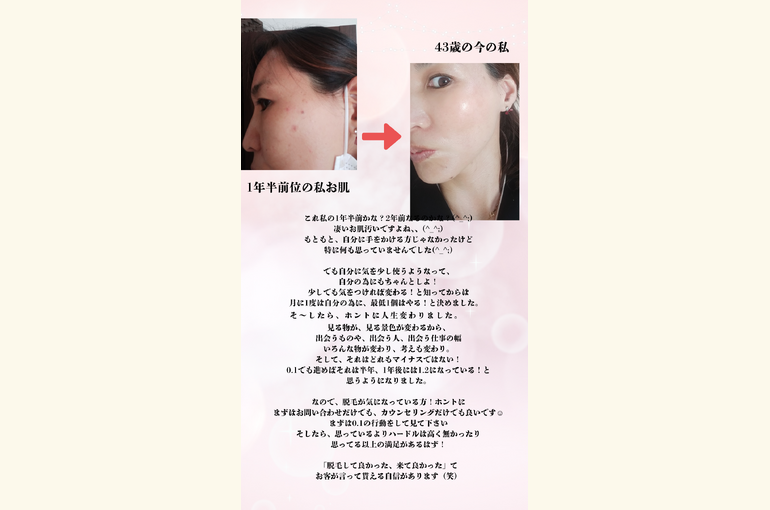 メンズ脱毛いつまで悩みますか？その時間でまずは問い合わせてみて！
