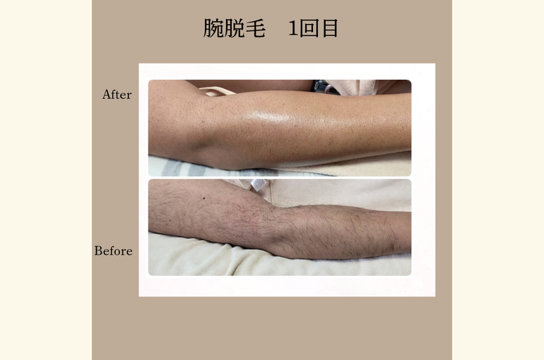 メンズ脱毛！1カ所￥990で体験！その後はいつ来ても全身脱毛￥11000