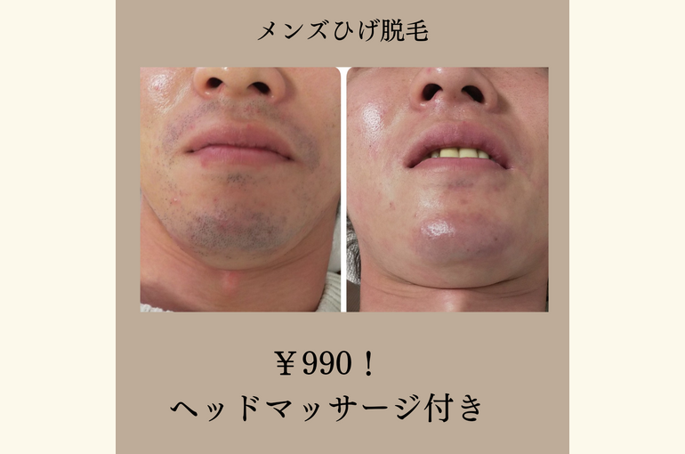 メンズ脱毛￥990円、まずはやろう！毛の無い男への一歩