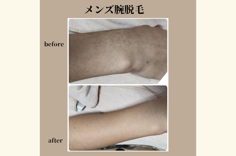 メンズ腕脱毛！え？毛生えたっけ？と思うくらい綺麗になります!
