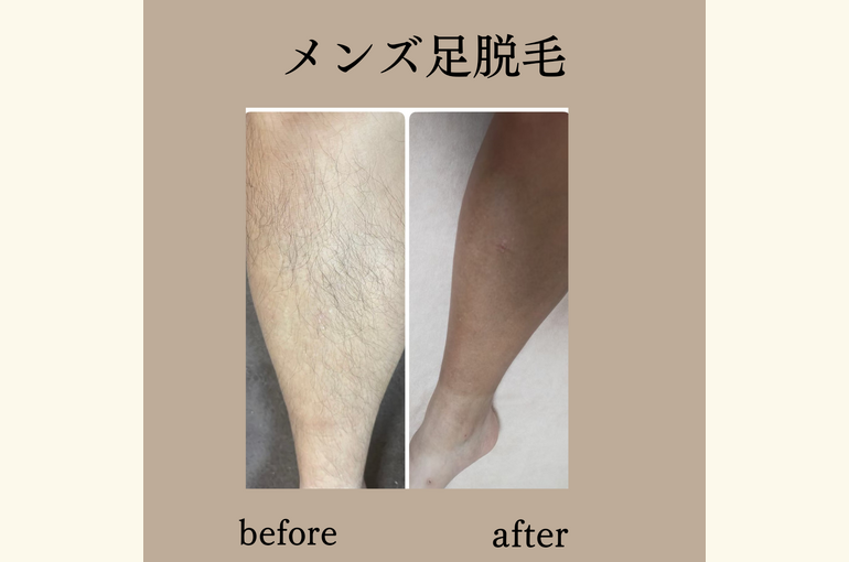 メンズ足脱毛、今から始めて来年の夏にすべすべに！