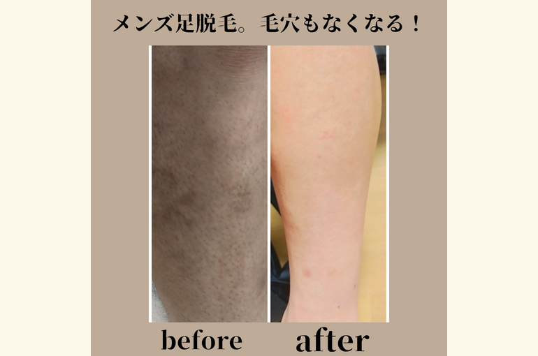 メンズエステ、足脱毛をして毛穴の無い引き締まった足へ！