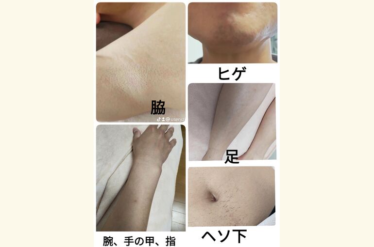 お好きな箇所を選んで組み合わせ脱毛！本気で無くしたい方！メンズ脱毛