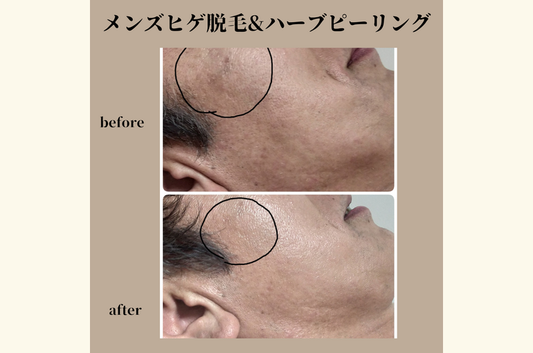 メンズエステ、ヒゲ脱毛と、ハーブピーリングでメンズエステ！