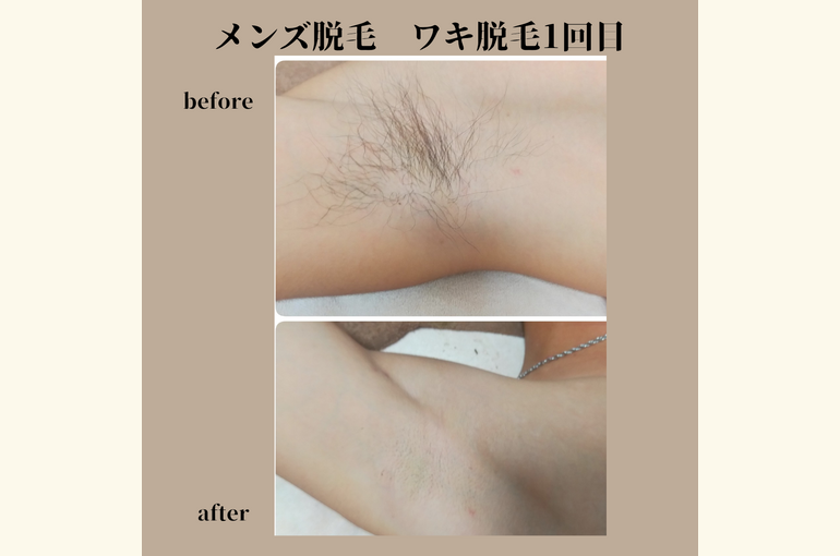 完全個室のメンズ脱毛！ワキ脱毛のビフォーアフターで清潔感たっぷり