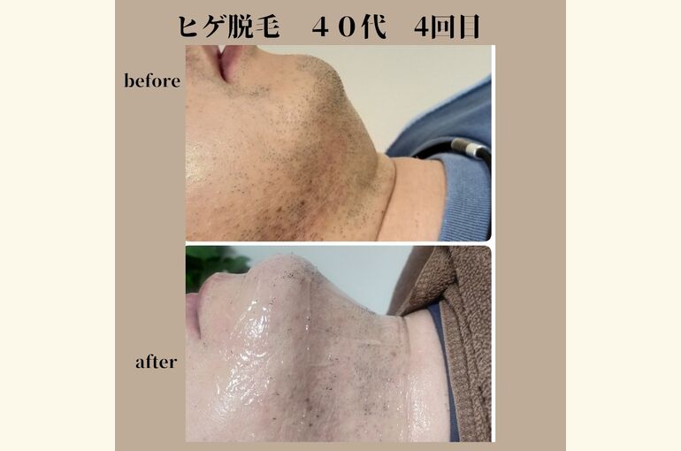 ヒゲ脱毛で、自信のある自分へ！メンズ脱毛がオススメ