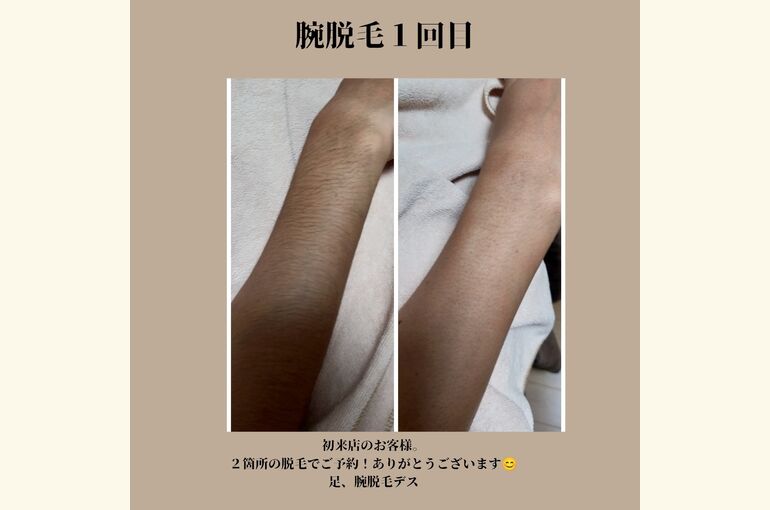 【メンズ脱毛】堺市でメンズ脱毛するならココ！安心の都度払いで効果有り!!口コミ高評価★
