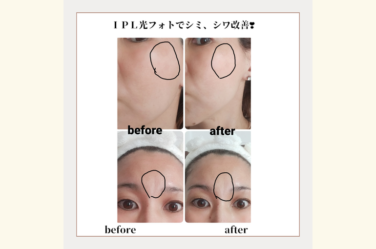 堺市北野田で、ＩＰＬ光フォトとパックが￥3500！シミ、シワ改善に！