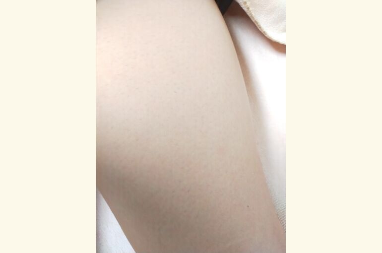 メンズ脱毛、自己処理では限界な箇所はお任せ下さい!