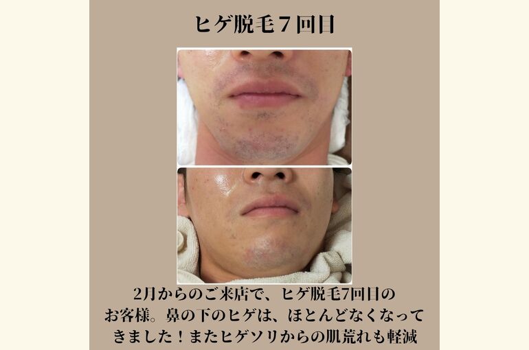 【メンズ】ヒゲ脱毛結果がでる！都度払いの完全予約制 堺市北野田honey-house