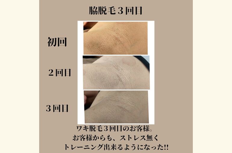 メンズ脱毛。ワキ脱毛がおススメ！夏までに綺麗に見せる肌！