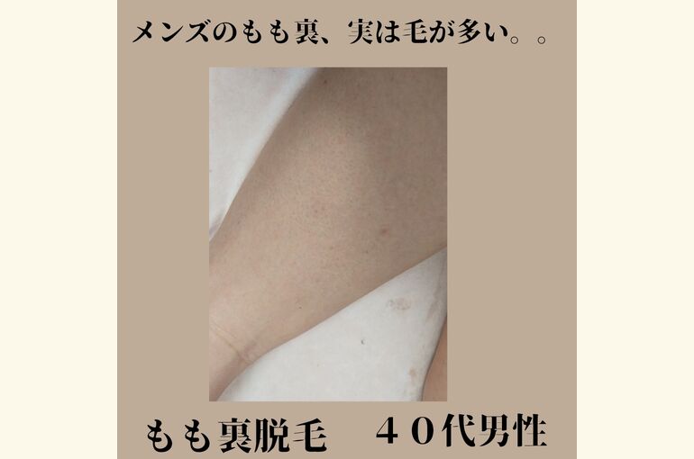 メンズ専門脱毛サロン。足のもも裏、意外と毛が濃い方が多い!