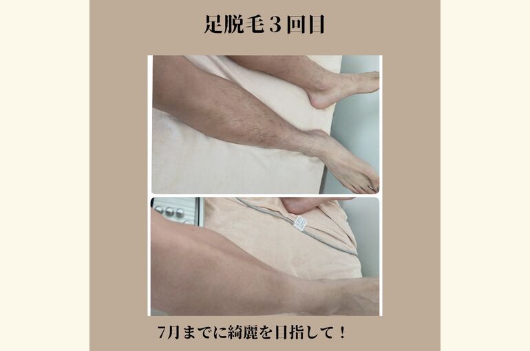メンズ学生も。脱毛はじめませんか？完全都度払いの脱毛サロン