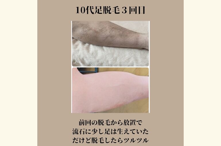 メンズ脱毛がオススメ!!夏までにザラザラしない足へ！安心の都度払い