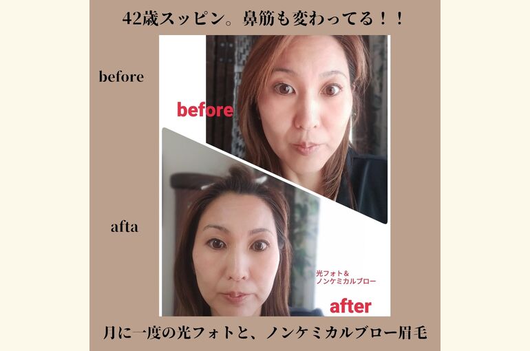 月に一度の光フォトフェイシャルと、ノンケミカルブロー眉毛セットで、お肌の若返り！