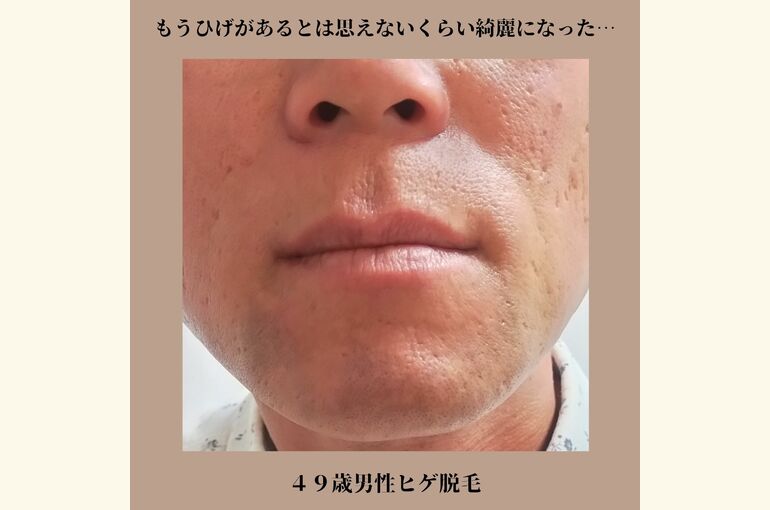 【メンズ】ヒゲ脱毛安い！都度払いの完全予約制 堺市北野田honey-house